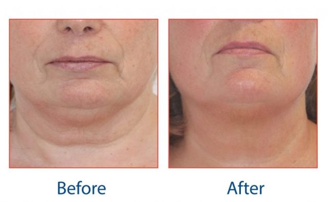 pro-max-facial-tightening-before-and-after