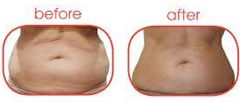shift fat with laser treatments, sparx beauty salon, winchester