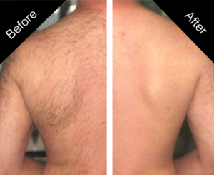 laser-hair-removal-before-and-after-sparx beauty salon winchester hampshire