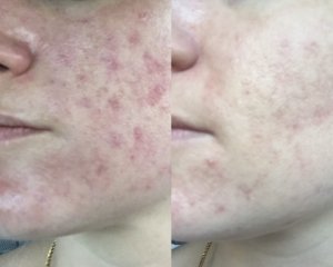 Alumier chemical skin peel results from Sparx Beauty Salon Winchester