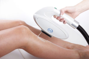 Laser Hair Removal with Lynton Laser at Sparx Winchester Beauty Salon