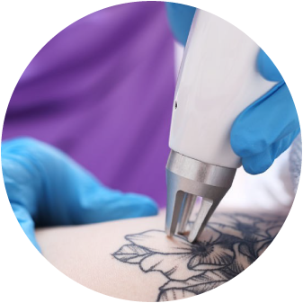 Tattoo Removal Winchester Laser Clinic