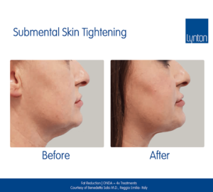 Fat Reduction Skin Tightening Jowls Winchester Skin Clinic RF Facials