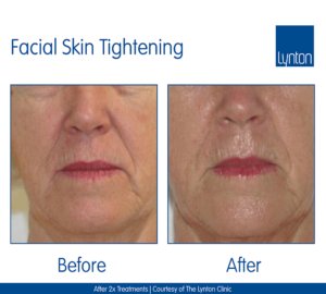 ProMax Lipo Facial Skin Tightening Winchester Skin Clinic