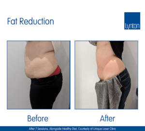 ProMax Lipo Fat Reduction Treatments Winchester Skin Clinic