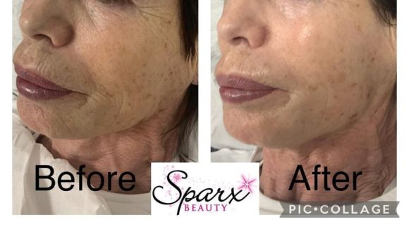 Before and After Golden Radio Frequency Facial Treatment at Sparx Winchester Skin clinic