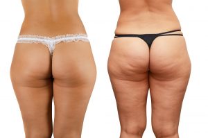 anti-cellulite-treatments, sparx beauty salon, winchester