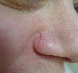 Thread Veins Sclerotherapy Winchester Skin Clinic