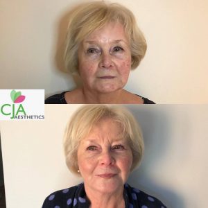 dermal fillers at Sparx Beauty Salon in Winchester