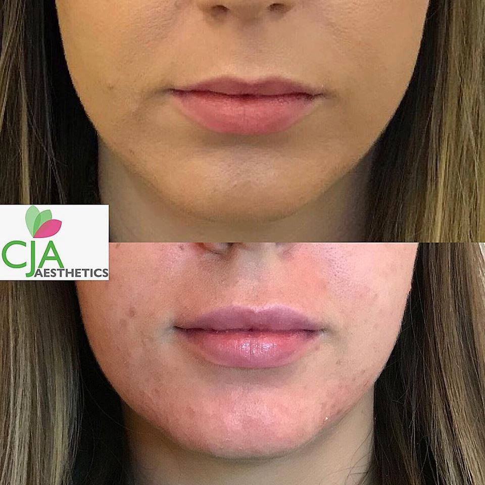 Lip Fillers at Sparx Aesthetics Clinic Winchester