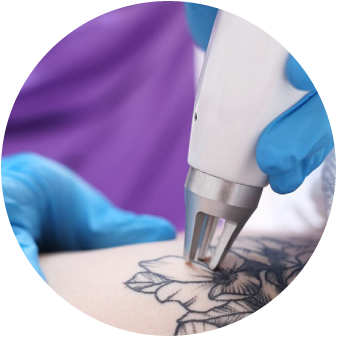 Tattoo Removal Winchester Laser Clinic Tattoo Removal Winchester Laser Clinic