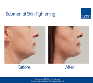 Non-Surgical Facelifts Fat Reduction Skin Tightening Jowls Winchester Skin Clinic RF Facials