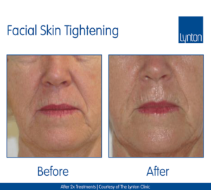 Non-Surgical Facelifts ProMax Lipo Facial Skin Tightening Winchester Skin Clinic