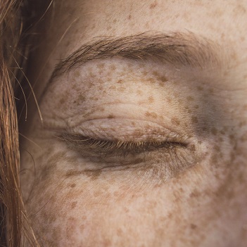 Reduce the appearance of age spots and pigmentation Reduce the appearance of age spots and pigmentation Winchester aesthetics clinic