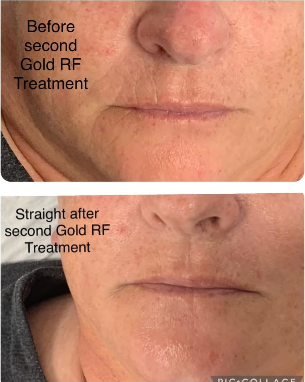 Golden RF Facial before and after Winchester skin clinic Sparx Golden RF Facial before and after Winchester skin clinic Sparx
