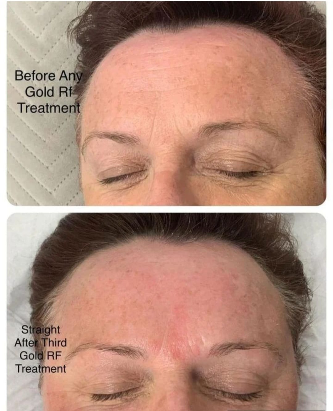 Golden RF Facial before and after Winchester skin clinic Golden RF Facial before and after Winchester skin clinic