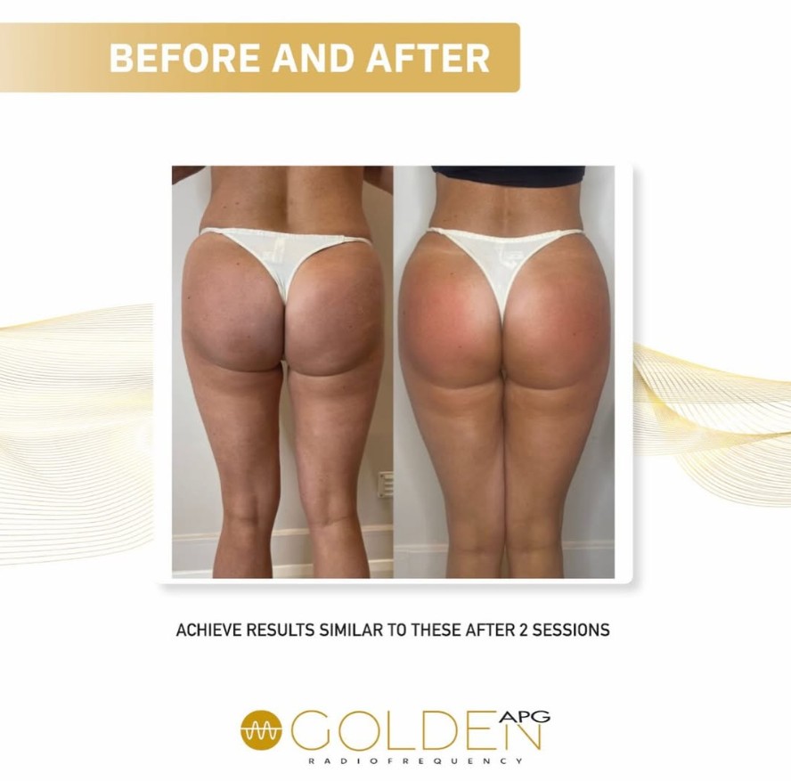 Before and After Golden RF Butt Lift Winchester Skin Clinic Sparx Before and After Golden RF Butt Lift Winchester Skin Clinic Sparx