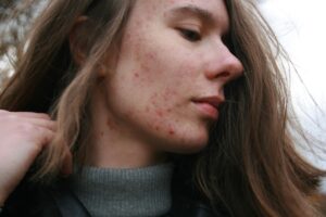 Acne scarring laser treatments Winchester Sparx