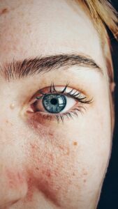 Rosacea treatments Winchester