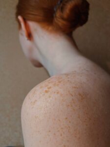 Skin pigmentation treatments Winchester at Sparx