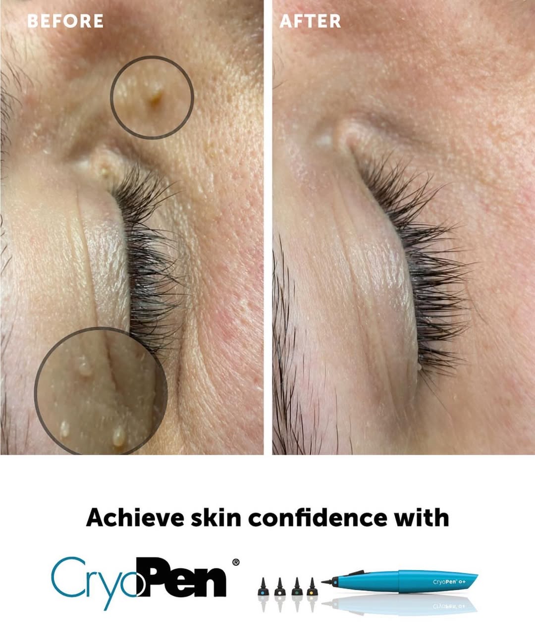 Cryotherapy skin tag removal available at Sparx Winchester aesthetics clinic Cryotherapy skin tag removal available at Sparx Winchester aesthetics clinic