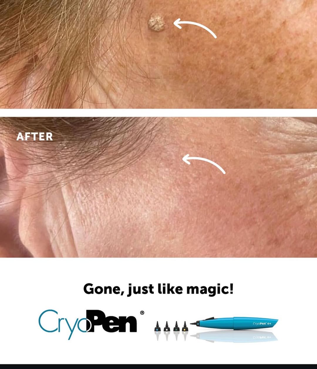 Cryotherapy wart removal available at Sparx Winchester skin clinic Pigmentation removal with cryotherapy at Sparx Winchester skin clinic