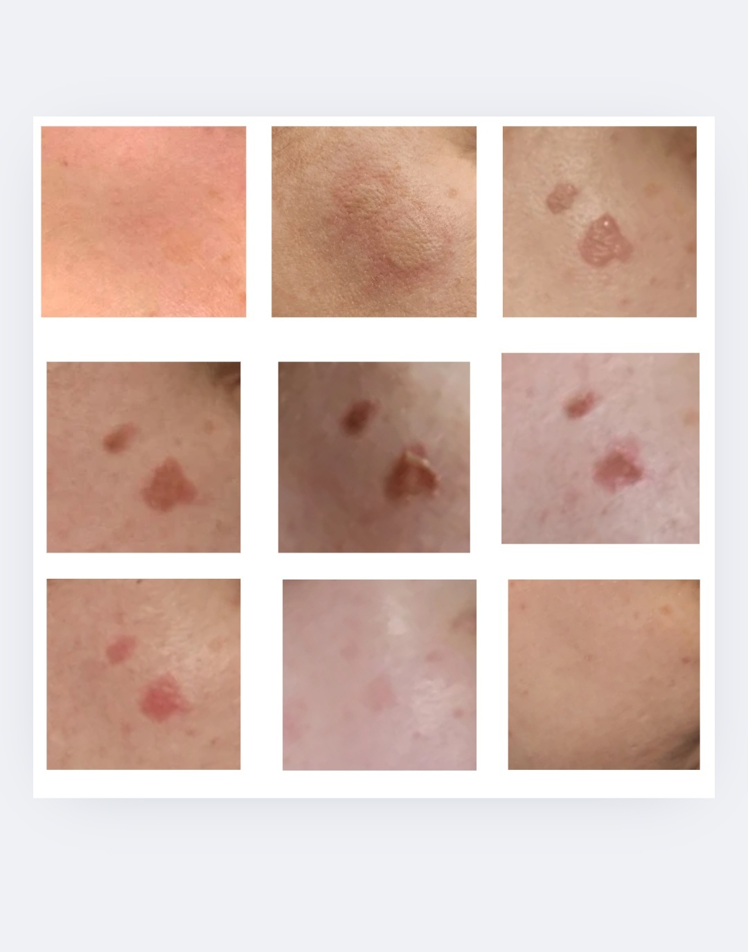 Snippet of Cryopen Pigmentation Removal at Sparx Aesthetics Clinic Winchester Pigmentation removal with cryotherapy at Sparx Winchester skin clinic