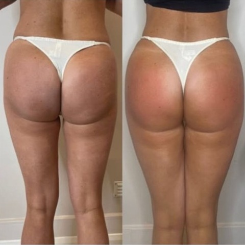Before and After Golden RF Butt Lift Winchester Skin Clinic Sparx