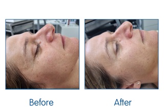 Laser Facial results at Winchester laser clinic