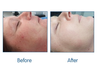 Before and After IllumiFacial at Winchester laser clinic