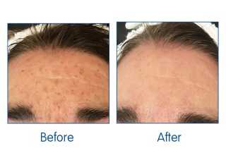 Before and After Laser Facial at Winchester laser clinic