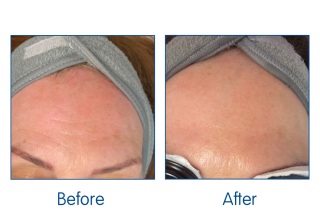 Before and After. illumiFacial at Winchester laser clinic