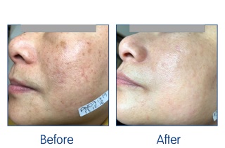 Laser Facial results at Winchester laser clinic