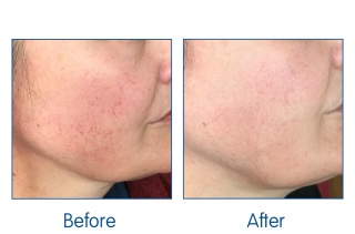 Laser Facial results at Winchester laser clinic