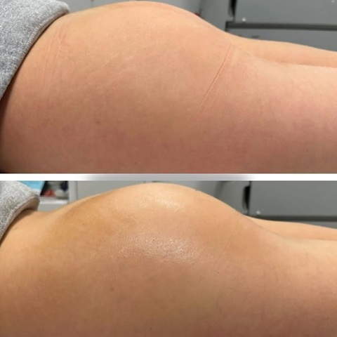 Golden RF Butt Lift Winchester Skin Clinic