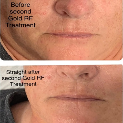 Golden RF Facial before and after Winchester skin clinic Sparx