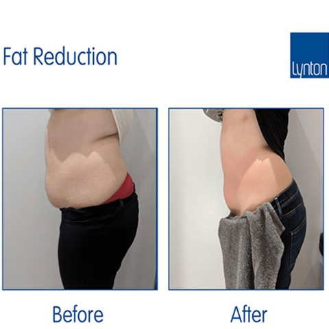 Lipo Fat Reduction Treatments Winchester Skin Clinic
