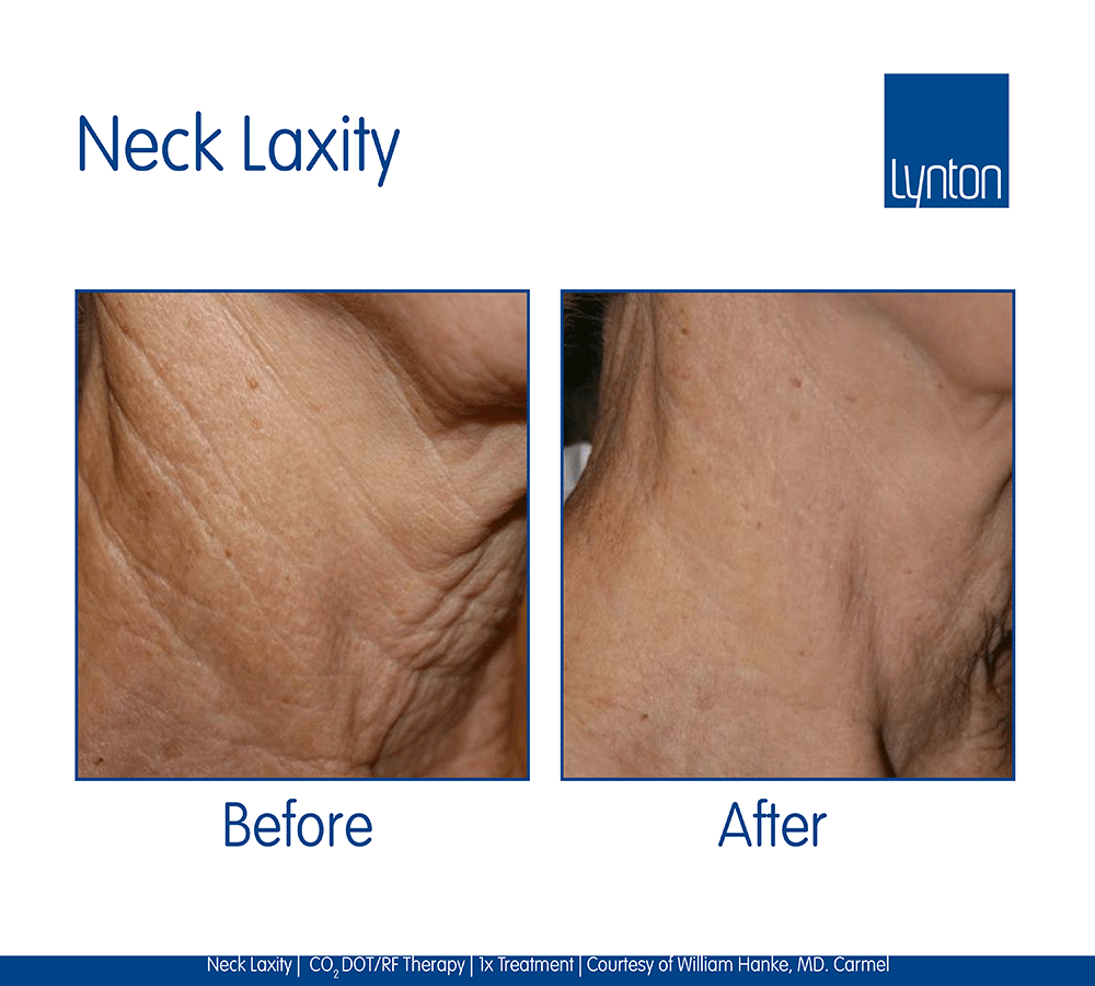 Skin Tightening for Neck Laxity in Winchester 