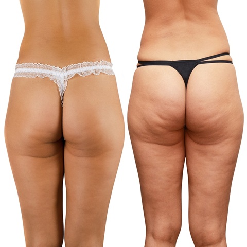 Anti-cellulite treatments Winchester Skin Clinic