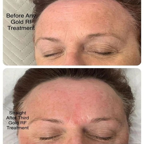 before & after radiofrequency treatments in Winchester
