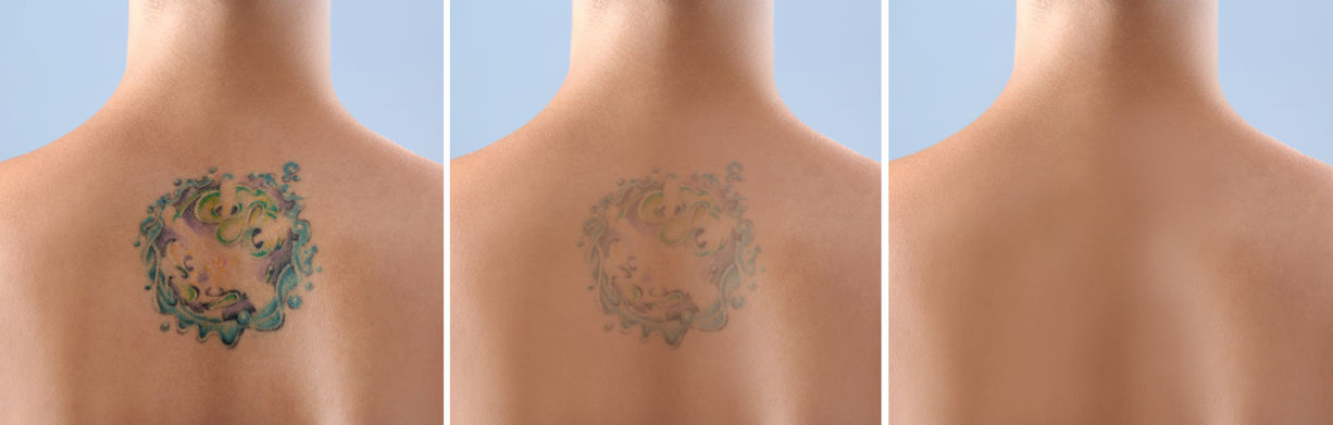 laser tattoo removal at sparx laser clinic winchester laser tattoo removal at sparx laser clinic winchester