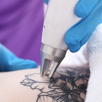 laser tattoo removal at winchester laser clinic laser tattoo removal at winchester laser clinic