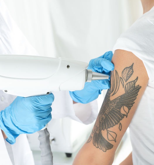 laser tattoo removal in Winchester laser tattoo removal in Winchester