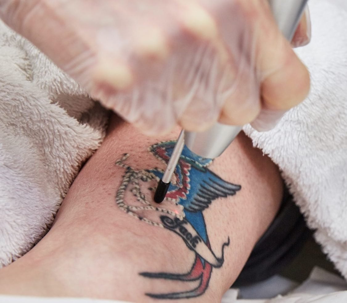 Laser tattoo removal Winchester Laser Clinic