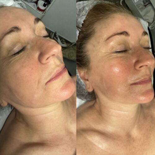 Filler Code Facial Offer