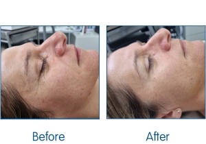 Before-and-After.-illumiFacial-available-in-Winchester-at-Sparx-Skin-Clinic