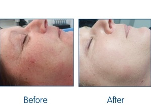 Before-and-After.-illumiFacial.-Excelight-available-at-Sparx-Winchester-Laser-Clinic