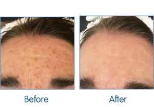 Before-and-After.-illumiFacial.-Excelight.-available-at-Sparx-Winchester-Laser-Clinic