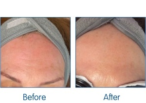 Before-and-After.-illumiFacial.-Lumina-available-at-Winchester-Laser-Clinic-Sparx