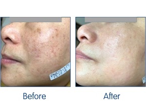 Before-and-After.-illumiFacial.-Lumina.-Laser-Skin-Solutions-available-at-Sparx-Skin-Clinic-Winchester